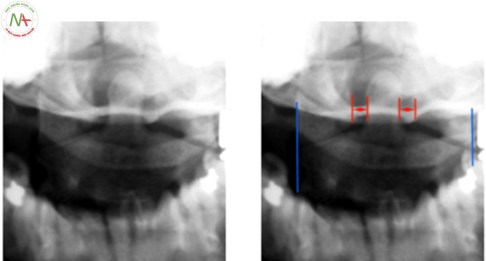 Hình 2. Chụp Xquang cột sống cổ cao tư thế thẳng há miệng