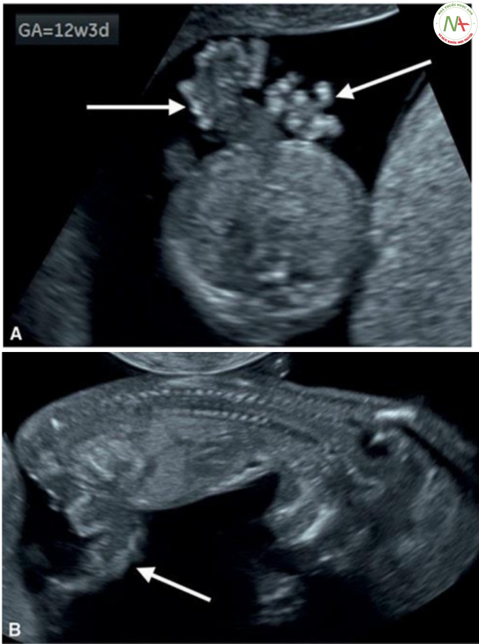 Hình 20: Mặt cắt ngang (A) và dọc (B) của một thai nhi 12 tuần tuổi bị hở thành bụng