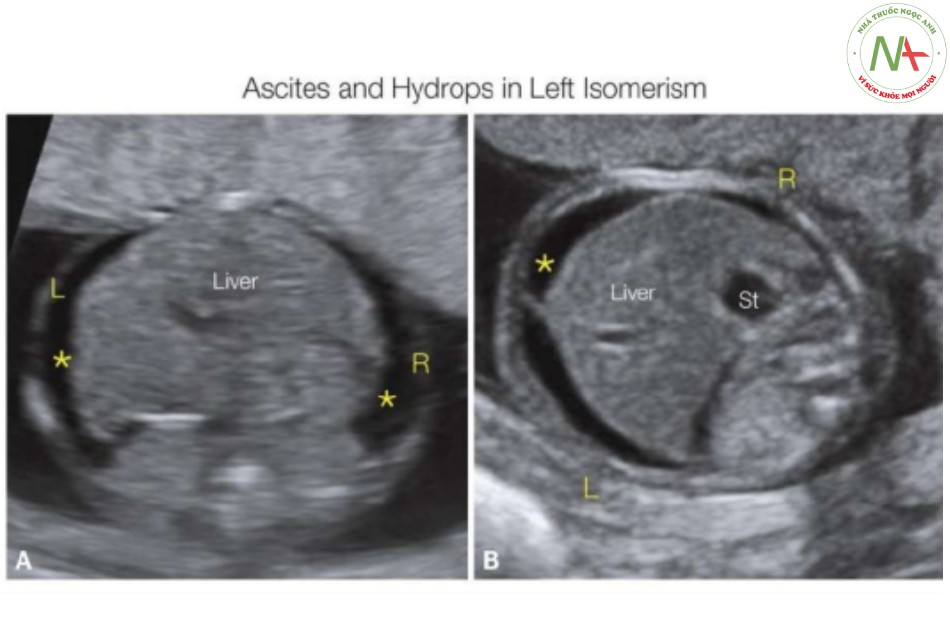 Hình 21: Mặt cắt ngang bụng ở hai thai nhi (A, B) với đồng dạng nhĩ trái và block tim