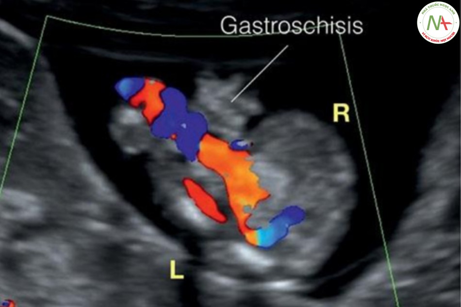 Hình 21: Mặt cắt ngang bụng thai nhi 12 tuần tuổi trong Doppler màu bị hở thành bụng