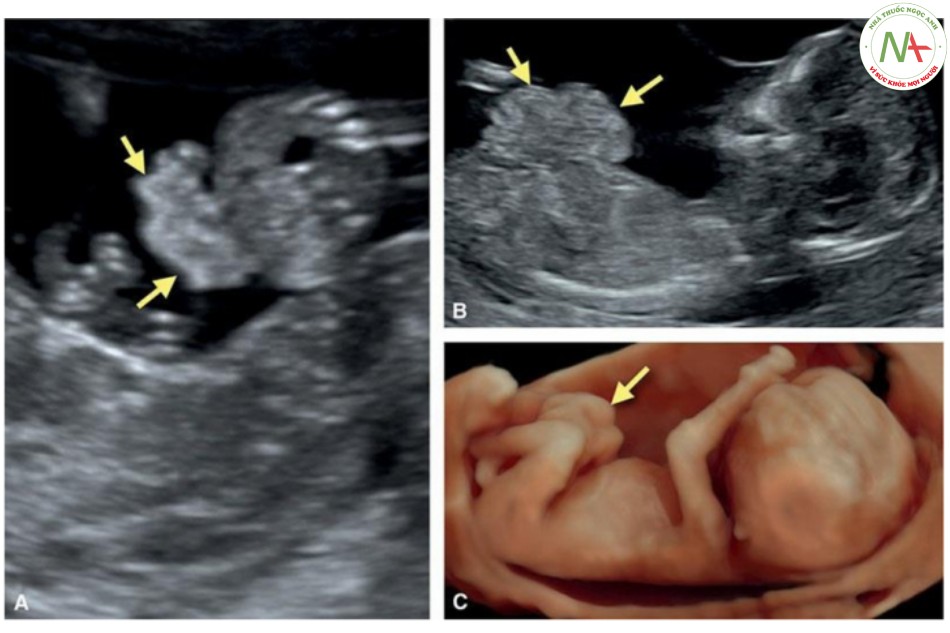 Hình 22: Mặt cắt ngang (A), dọc (B) trên siêu âm hai chiều và siêu âm ba chiều tương ứng ở chế độ bề mặt (C) của một thai nhi 13 tuần tuổi bị hở thành bụng.