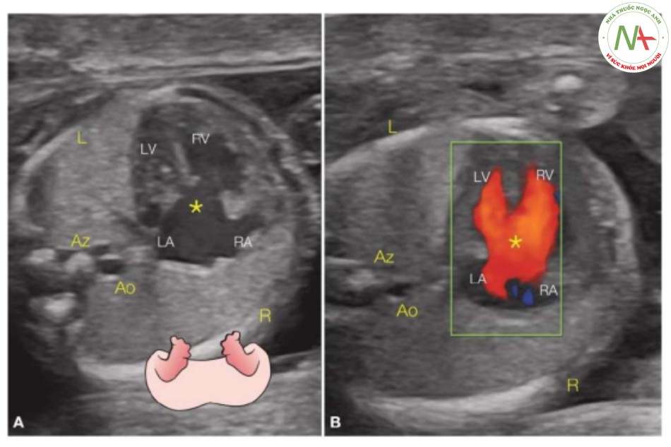 Hình 22: Mặt cắt ngang ngực thai nhi trong thang xám (A) và Doppler màu (B) ở thai nhi có kênh nhĩ thất toàn phần (dấu hoa thị) và đồng dạng bên trái
