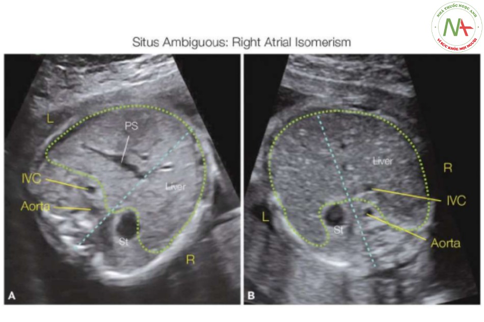 Hình 23: Hình A và B cho thấy mặt cắt ngang bụng ở hai thai nhi có situs mơ hồ, với đồng dạng nhĩ phải