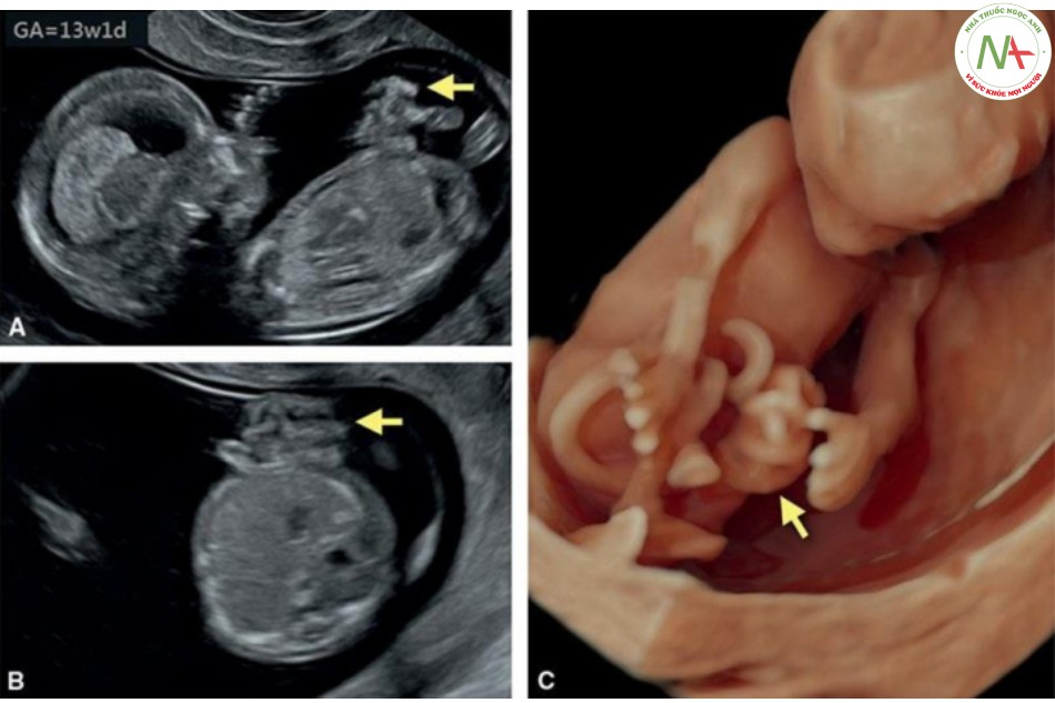 Hình 23: Mặt cắt dọc bên (A) và ngang (B) trên siêu âm hai chiều và siêu âm ba chiều (3D) tương ứng ở chế độ bề mặt (C) của một thai nhi 13 tuần tuổi bị hở thành bụng