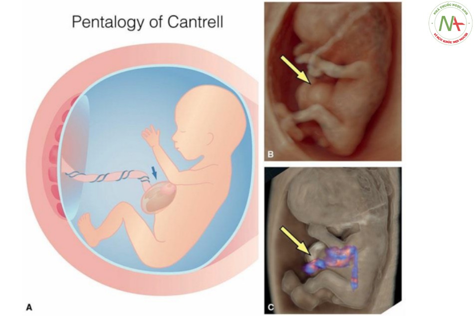 Hình 24: Hình vẽ giản đồ (A) và hình ảnh siêu âm 3D tương ứng ở chế độ bề mặt (B) và chế độ cơ thể trong suốt (C) ở thai nhi 11 tuần tuổi có ngũ chứng Cantrell