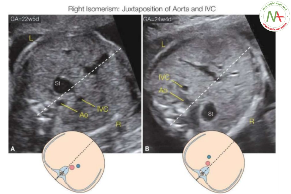 Hình 24: Mặt cắt ngang bụng thai nhi, cùng với hình vẽ giản đồ, ở hai thai nhi (A, B) với đồng dạng nhĩ phải