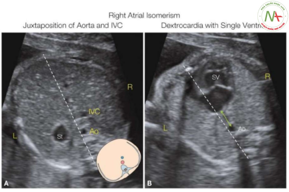 Hình 25: Mặt cắt ngang bụng (A) (cùng với hình vẽ giản đồ) và ngực (B) thai nhi có đồng dạng bên phải