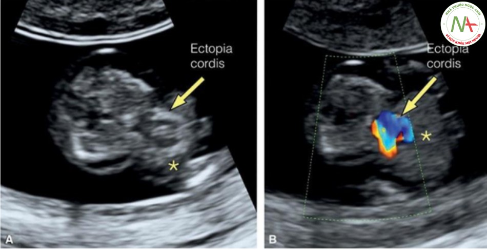 Hình 25: Mặt cắt ngang lồng ngực trong thang xám (A) và Doppler màu (B) ở thai nhi 11 tuần tuổi có ngũ chứng Cantrell