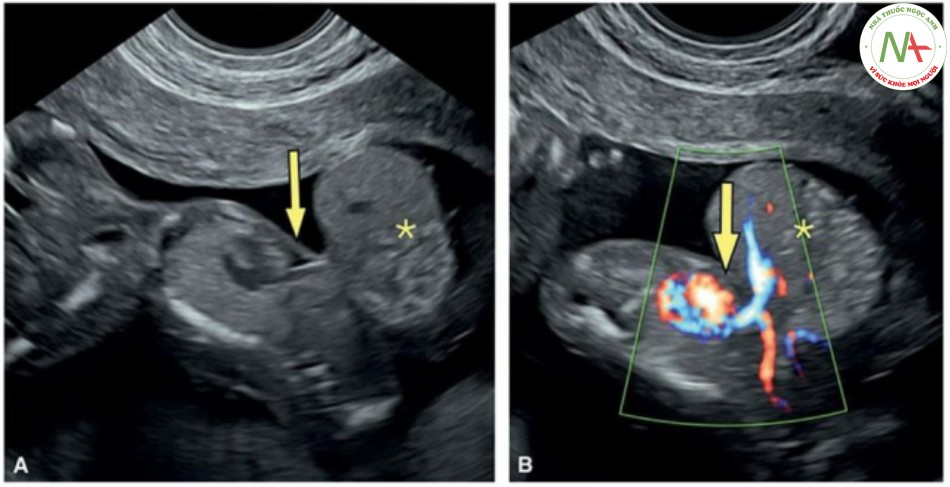 Hình 26: Mặt cắt dọc của ngực và bụng trong thang xám (A) và Doppler màu B) ở thai nhi 13 tuần tuổi có ngũ chứng Cantrell nhẹ với tim lạc chỗ một phần