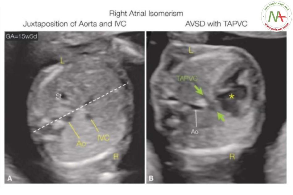 Hình 26: Mặt cắt ngang bụng (A) và ngực (B) ở thai nhi 15 tuần tuổi với đồng dạng bên phải