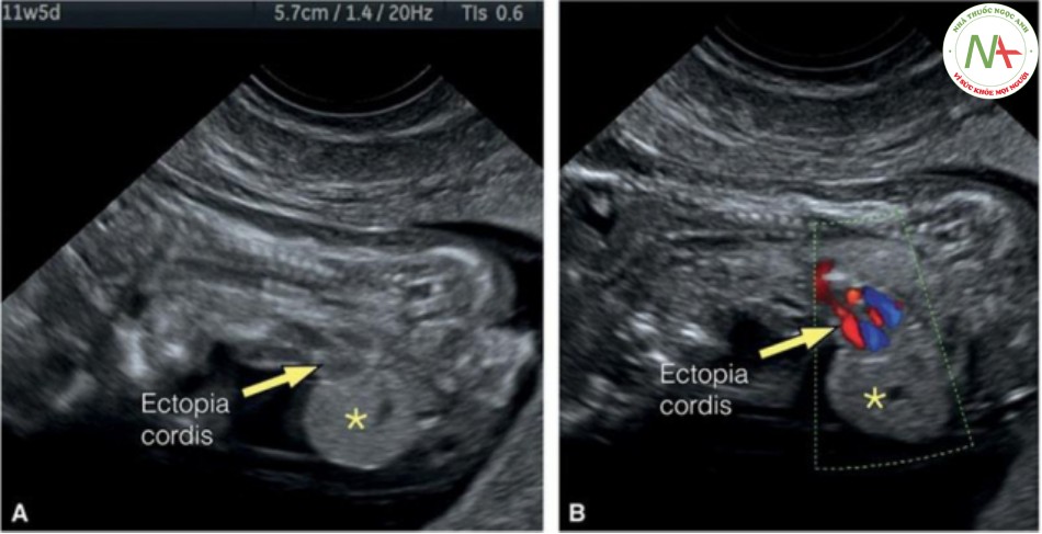 Hình 27: Mặt cắt dọc của ngực và bụng trong thang xám (A) và Doppler màu (B) ở một thai nhi 11 tuần tuổi có ngũ chứng Cantrell