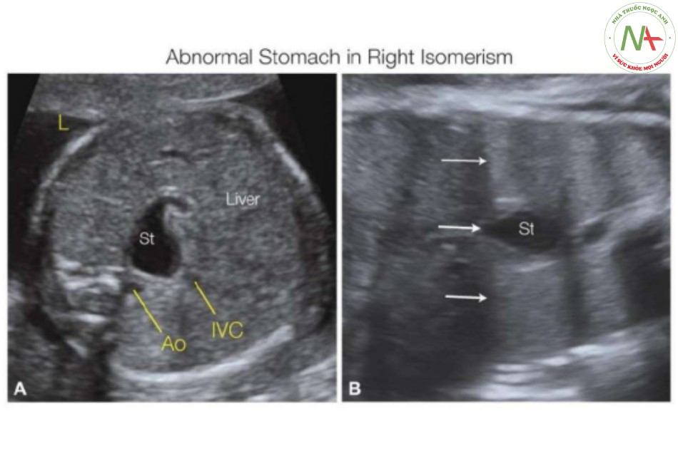 Hình 27: Mặt cắt ngang (A) và vành (B) của bụng trên ở hai thai nhi (A, B) với đồng dạng nhĩ phải