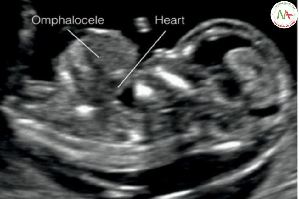Hình 28: Mặt cắt dọc của ngực và bụng ở thai nhi 12 tuần tuổi có thoát vị rốn cao và tim lạc chỗ như một phần của ngũ chứng Cantrell