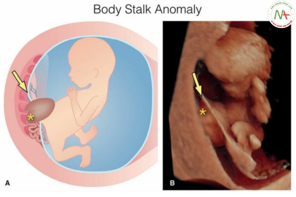 Hình 29: Hình vẽ giản đồ (A) và hình ảnh siêu âm 3D tương ứng ở chế độ bề mặt (B) ở một thai nhi 11 tuần tuổi có bất thường phức hợp cơ thể