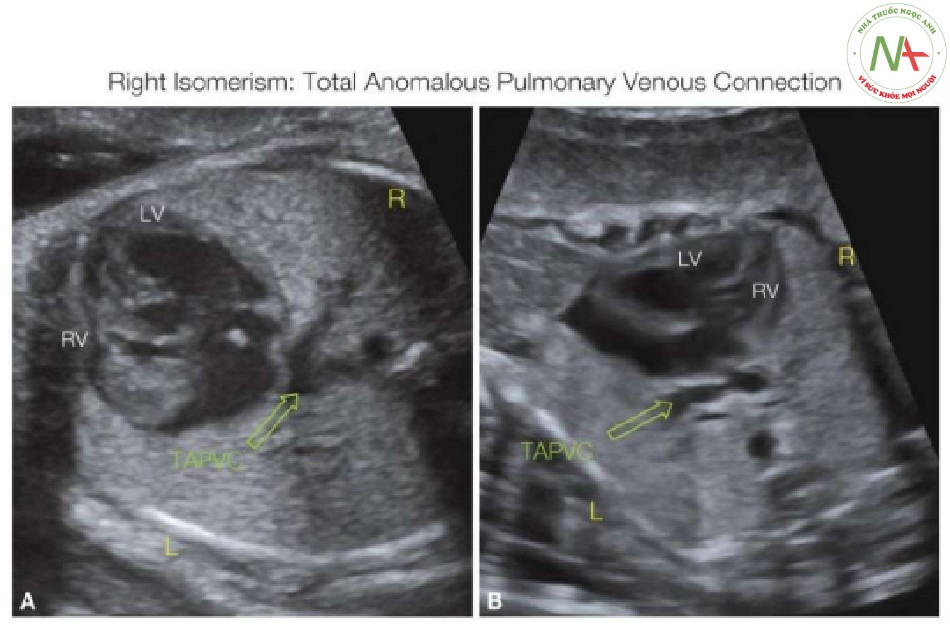 Hình 29: Mặt cắt ngang ngực trong thang xám ở hai thai nhi (A, B) với dextrocardia và đồng dạng bên phải