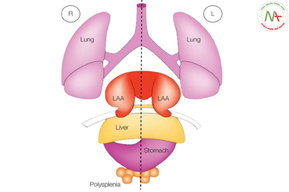 Hình 2: Hình vẽ giản đồ các tạng trong ổ bụng và lồng ngực, nhìn từ trước, trong đồng dạng nhĩ trái (đa lách)