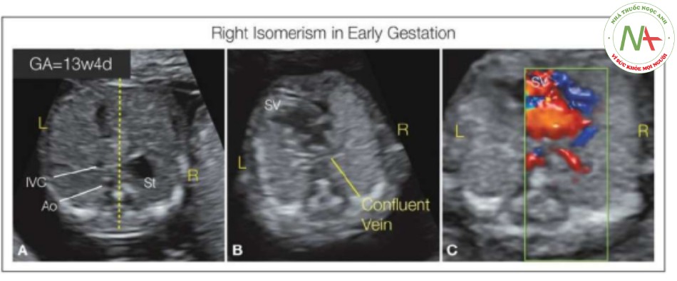 Hình 30: Mặt cắt ngang bụng (A) và ngực (B, C) trong thang xám ở thai nhi 13 tuần tuổi có đồng dạng bên phải, siêu âm qua ngả âm đạo
