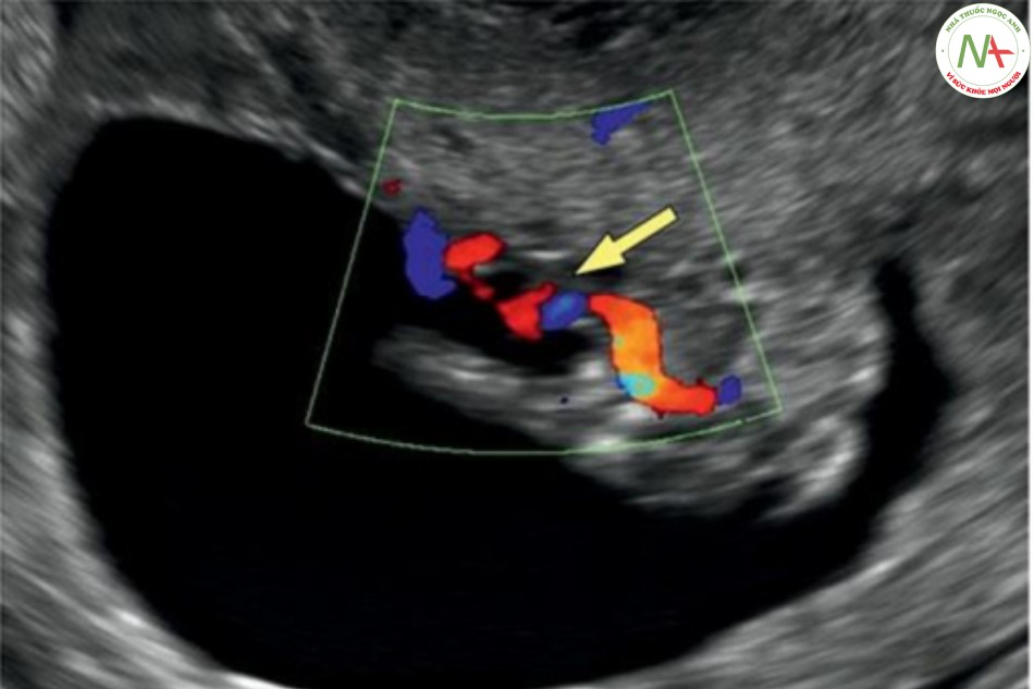 Hình 31: Mặt cắt ngang bụng trong Doppler màu ở thai nhi 12 tuần tuổi có bất thường phức hợp cơ thể
