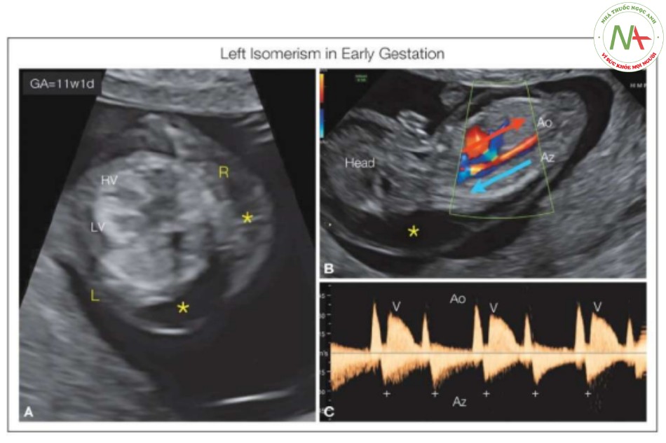 Hình 31: Phù thai và độ mờ da gáy dày (dấu hoa thị) là những chỉ định chuyển tuyến ở thai nhi 11 tuần tuổi