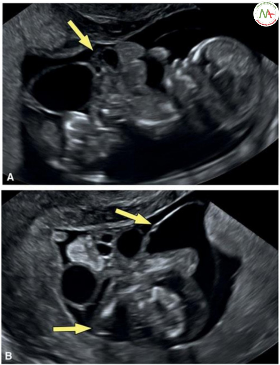 Hình 32: Hình ảnh siêu âm của thai nhi 12 tuần tuổi với OEIS