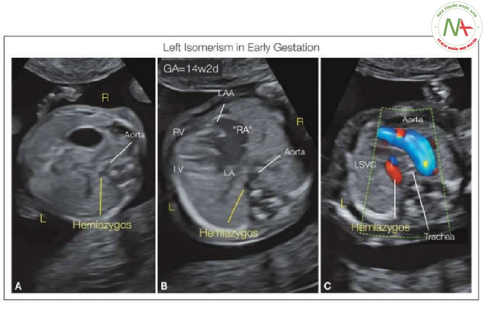 Hình 32: Thai nhi 14 tuần tuổi có đồng dạng bên trái được siêu âm qua ngả âm đạo