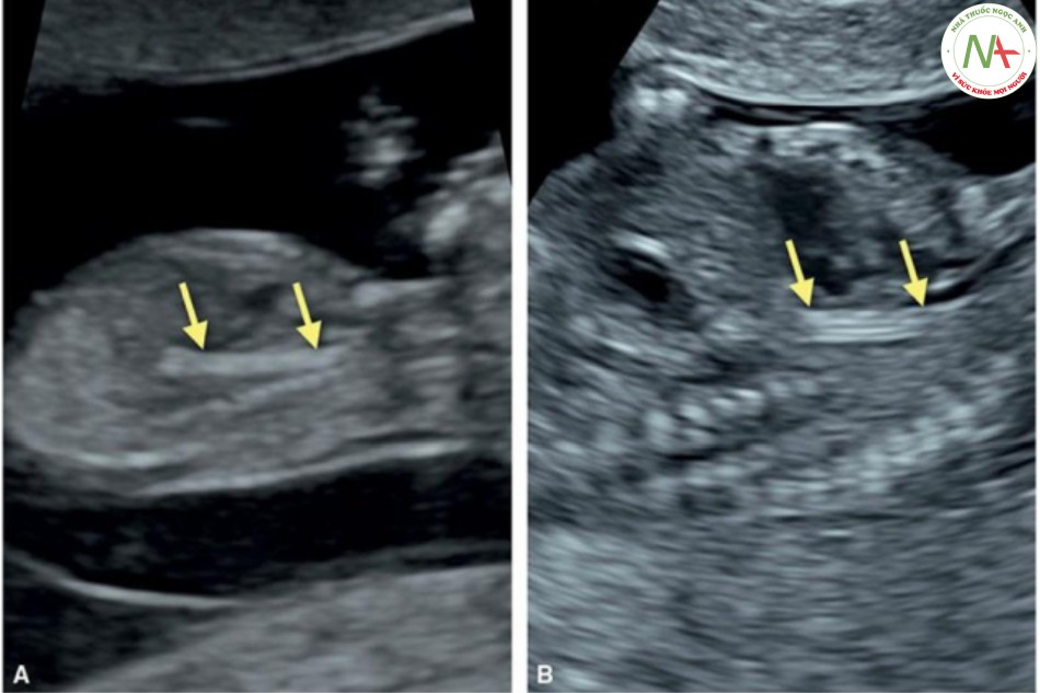 Hình 34: Hình ảnh siêu âm mặt cắt dọc giữa qua thành bụng (A) và qua ngả âm đạo (B) của ngực và bụng trên ở hai thai nhi 13 tuần tuổi