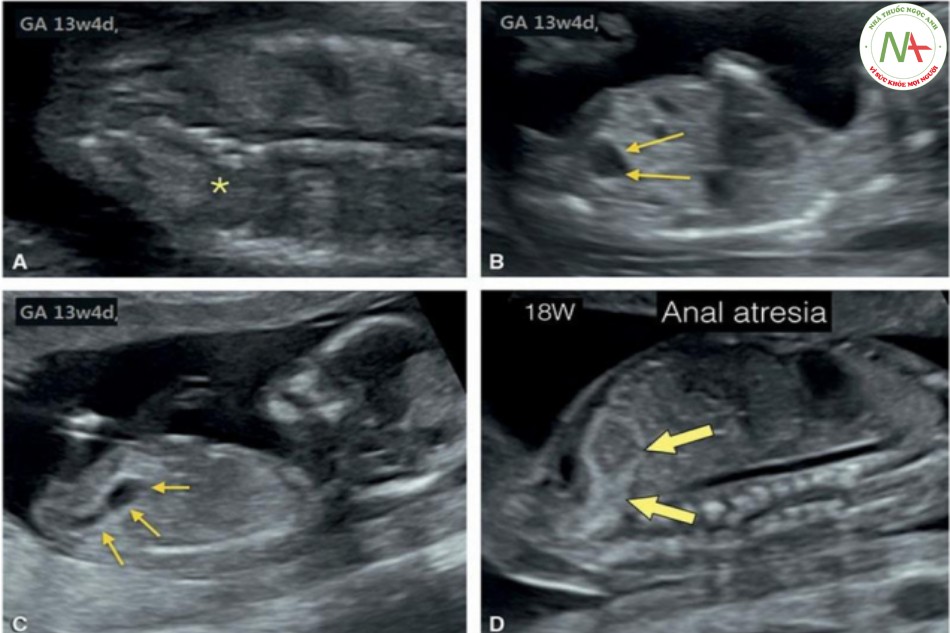 Hình 36: Hình ảnh siêu âm của một thai nhi có hội chứng VATER, nghi ngờ đầu tiên lúc 13 tuần tuổi