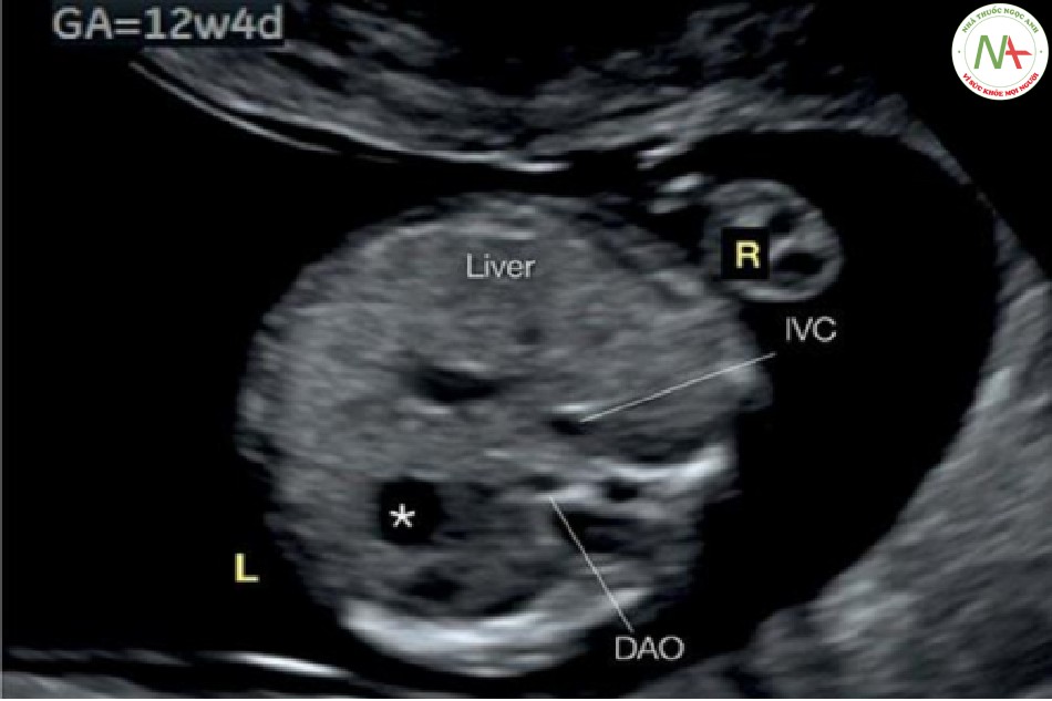 Hình 37: Mặt cắt ngang bụng trên ở thai nhi bình thường 12 tuần tuổi và hình ảnh siêu âm qua ngả âm đạo có độ phân giải cao