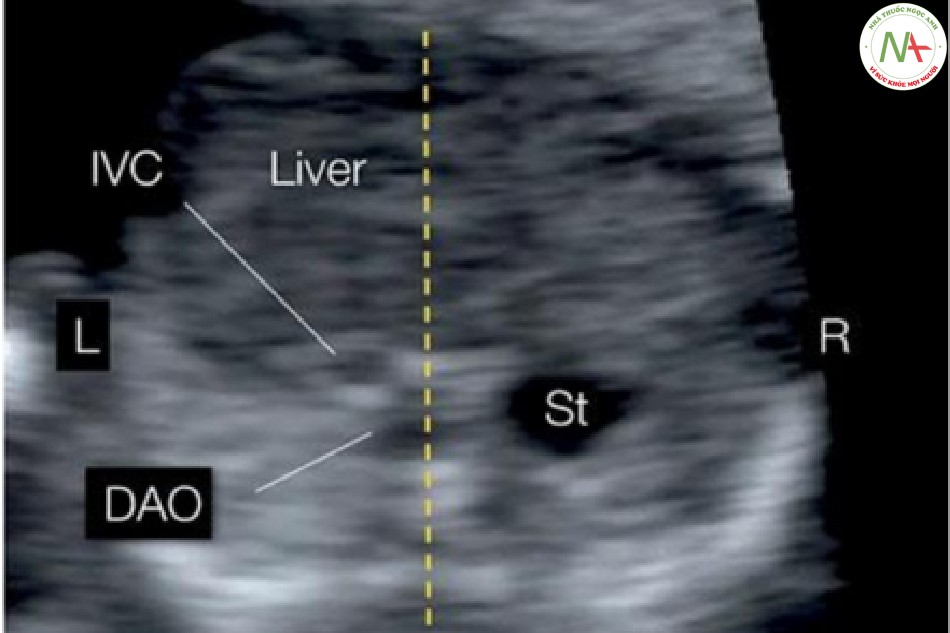 Hình 38: Mặt cắt ngang bụng trên cho thấy vị trí các cơ quan trong ổ bụng bất thường ở thai nhi 13 tuần tuổi có đồng phân phải nghi ngờ do dị tật tim phức tạp