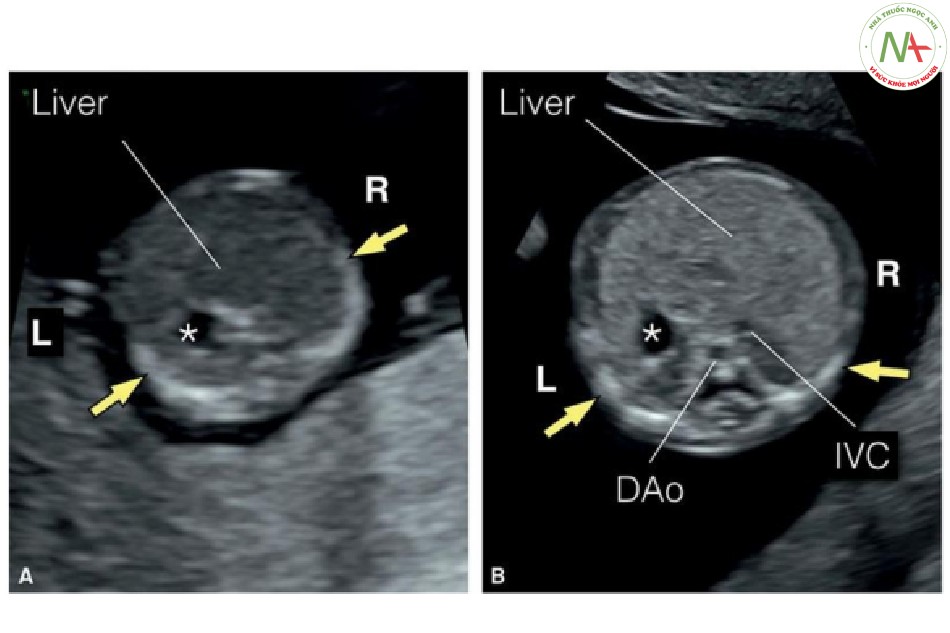 Hình 3: Mặt cắt ngang bụng trên của hai thai nhi 13 tuần tuổi