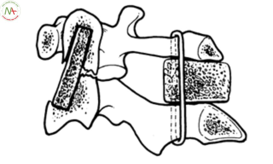 Hình 4. Minh họa ghép xương C1 - C2