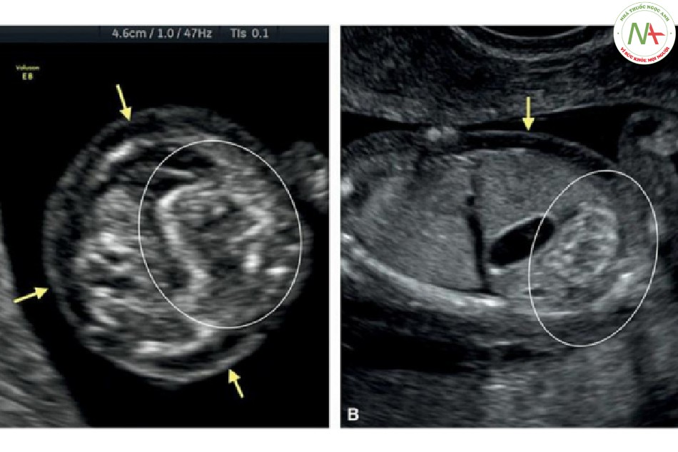 Hình 40: Mặt cắt ngang (A) ở 12 tuần tuổi và mặt cắt dọc bên (B) ở 13 tuần tuổi ở hai thai nhi có ruột tăng âm (hình tròn) và trisomy 21