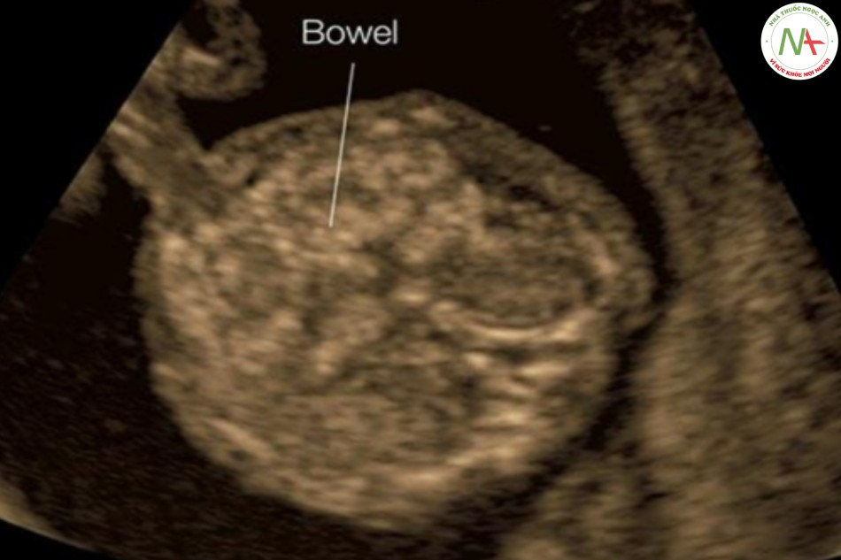 Hình 41: Mặt cắt ngang bụng thai nhi 13 tuần tuổi thu được khi siêu âm qua ngả âm đạo
