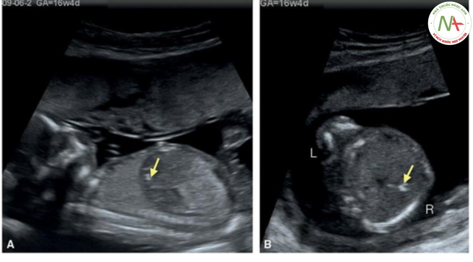 Hình 43: Mặt cắt dọc (A) và ngang (B) của cùng một thai nhi ở 16 tuần tuổi. Lưu ý nang lớn trong gan đã thoái triển trong vòng 3 tuần