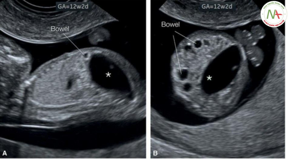 Hình 44: Mặt cắt dọc (A) và ngang (B) của thai nhi 12 tuần tuổi có bàng quang lớn (dấu hoa thị) và giãn các quai ruột liền kề có thành hồi âm dày.