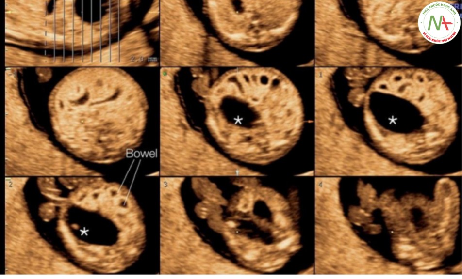 Hình 45: Siêu âm ba chiều ở chế độ hiển thị cắt lớp của một thai nhi 12 tuần tuổi có bàng quang lớn và các quai ruột giãn