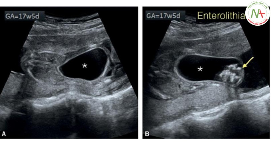 Hình 46: Mặt cắt ngang (A và B) của cùng một thai nhi như trong Hình 44 và 45, lúc này ở 17 tuần tuổi