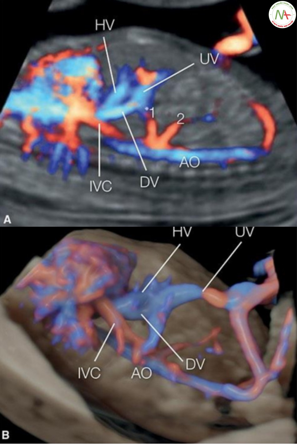 Hình 47: Mặt cắt dọc của ngực và bụng trong Doppler màu (A) và 3D ở chế độ cơ thể trong suốt (B) ở một thai nhi bình thường 13 tuần tuổi