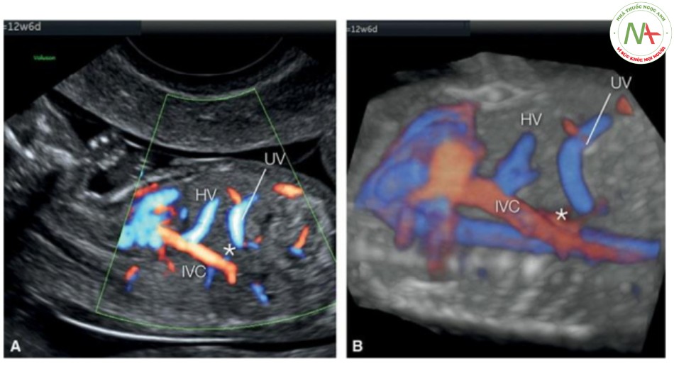 Hình 48: Mặt cắt dọc của ngực và bụng trong Doppler màu (A) và 3D ở chế độ cơ thể trong suốt (B), ở một thai nhi 12 tuần tuổi bị bất sản ống tĩnh mạch (dấu hoa thị)