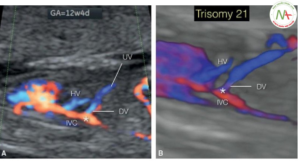 Hình 49: Mặt cắt dọc của ngực và bụng trong Doppler màu (A) và 3D ở chế độ cơ thể trong suốt (B) ở thai nhi 12 tuần tuổi bị trisomy 21