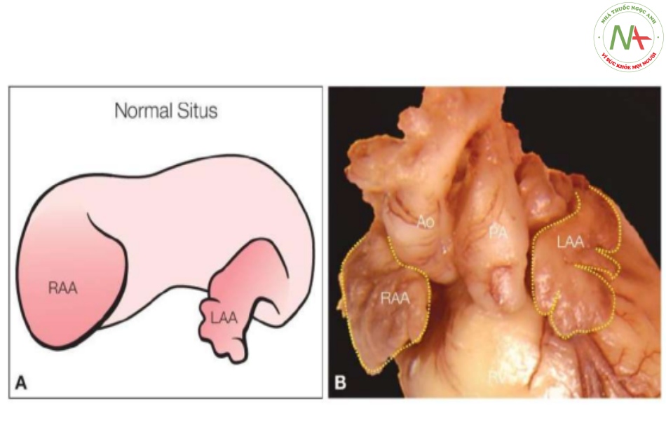 Hình 4: Hình vẽ giản đồ (A) và tiêu bản giải phẫu (B) của tim thai bình thường