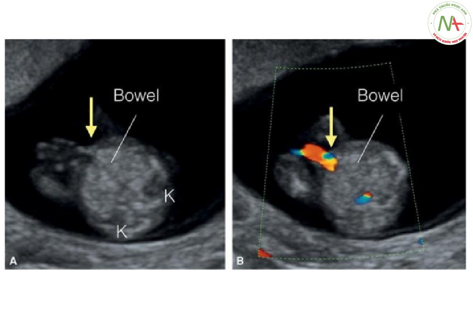 Hình 4: Mặt cắt ngang bụng giữa trong thang xám (A) và Doppler màu (B) ngang mức độ dây rốn cắm vào (mũi tên) ở thai nhi 12 tuần tuổi