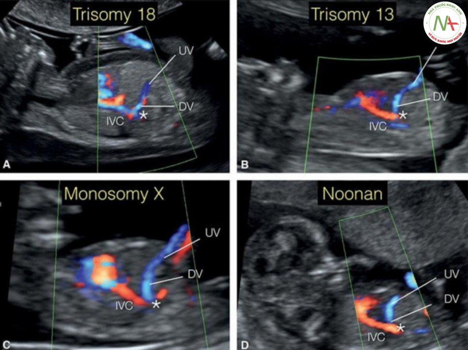 Hình 50: Mặt cắt dọc của bụng trong Doppler màu ở bốn thai nhi tương ứng bị trisomy 18 (A), trisomy 13 (B), monosomy X (C) và hội chứng Noonan (D), thu được từ 12 đến 13 tuần tuổi