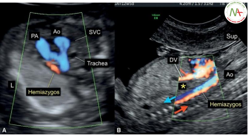 Hình 52: Mặt cắt ba mạch máu khí quản (A) và mặt cắt dọc (B) trong Doppler màu của thai nhi 12 tuần tuổi có sự liên tục của tĩnh mạch bán đơn