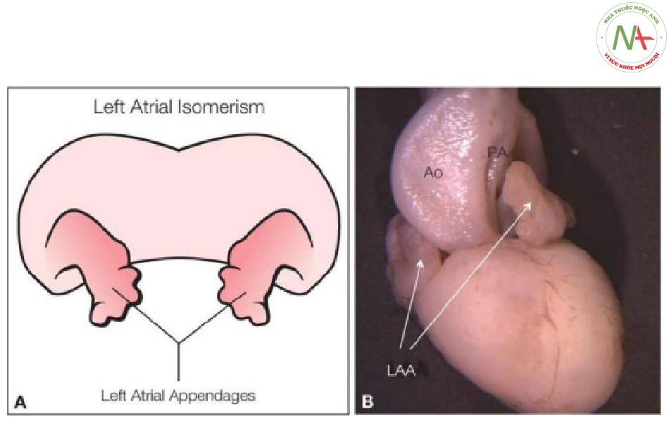 Hình 5: Hình vẽ giản đồ (A) và tiêu bản giải phẫu (B) tim thai, nhìn từ trước