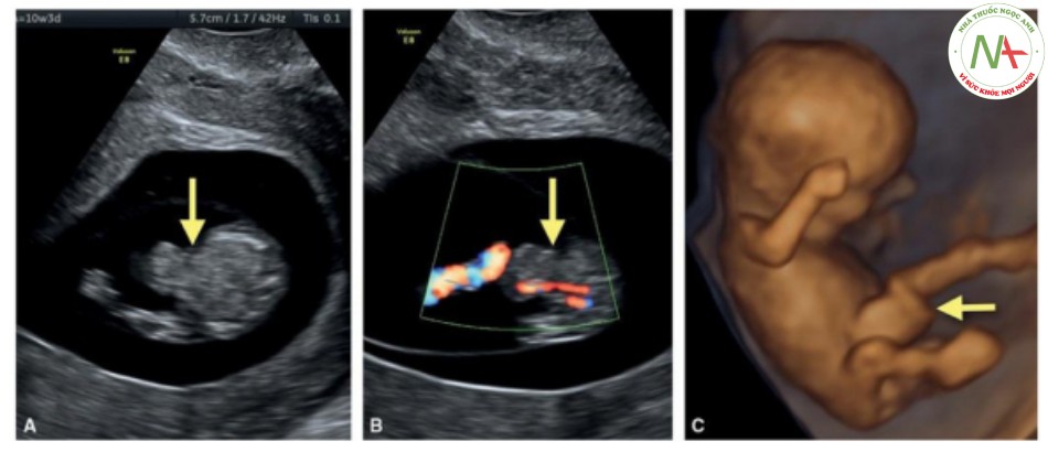 Hình 5: Mặt cắt ngang bụng thai nhi trong thang xám (A) và Doppler màu (B) của thai nhi 10 tuần