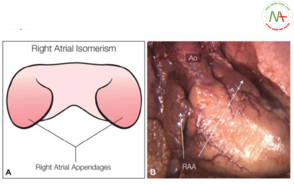 Hình 6: Hình vẽ giản đồ (A) và tiêu bản giải phẫu (B) của tim thai