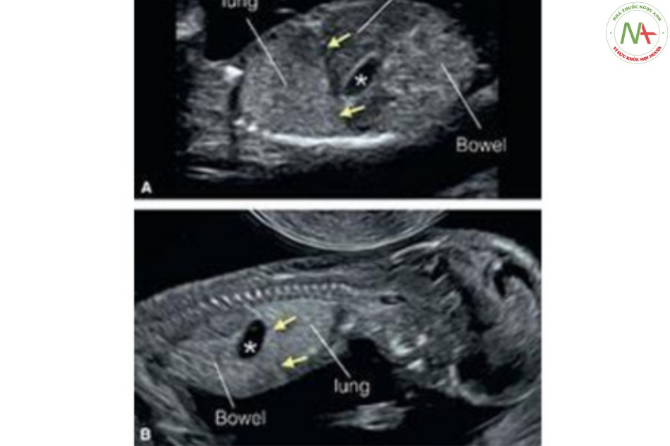 Hình 7: Mặt cắt dọc bên ở hai thai nhi 13 (A) và 12 (B) tuần tuổi cho thấy ngực và bụng.