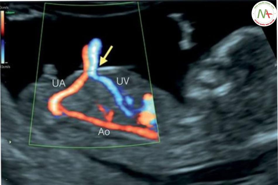 Hình 8: Mặt cắt dọc giữa của thai nhi 13 tuần tuổi trong Doppler màu