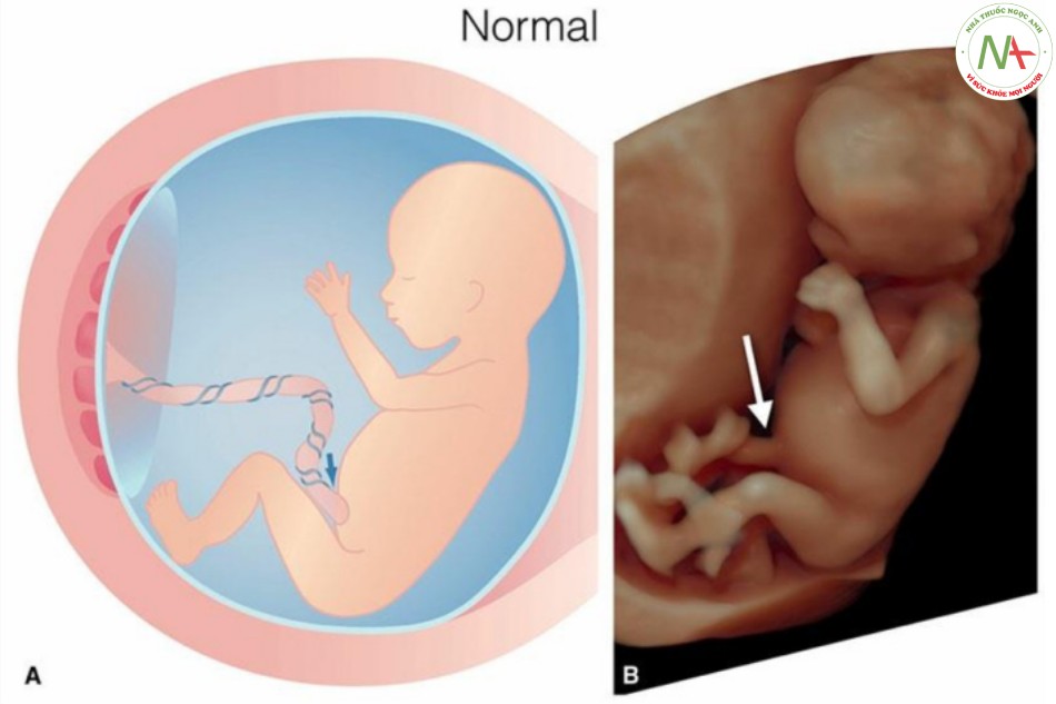 Hình 9: Hình vẽ giản đồ (A) và hình ảnh siêu âm 3D tương ứng ở chế độ bề mặt của thai nhi 12 tuần tuổi